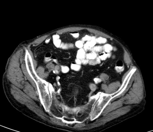 File:Hufeisenniere 07 - CT - axial - 001.jpg