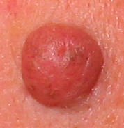 Mole (body part).jpg