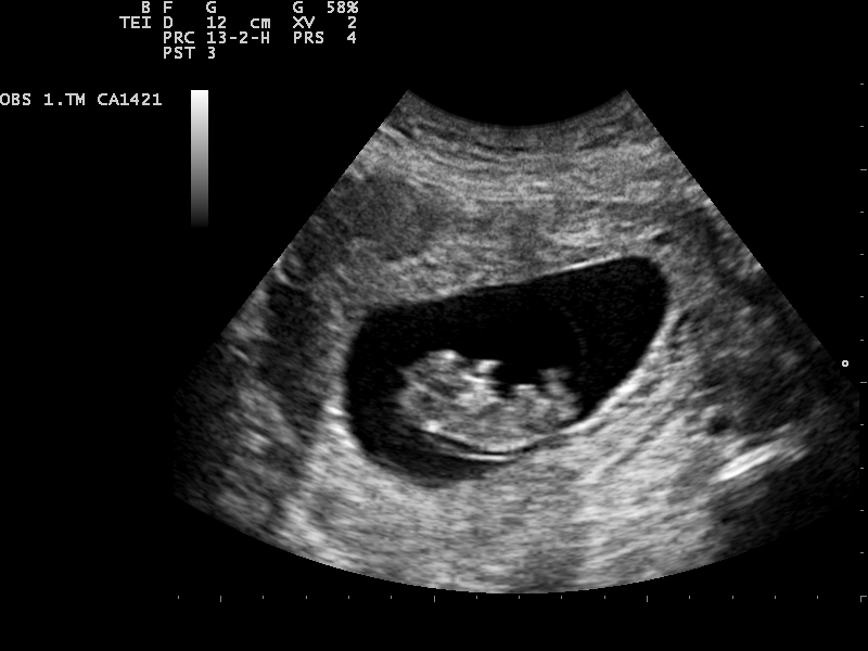 File:Ultrasound Scan ND 0105143736 1439322.png