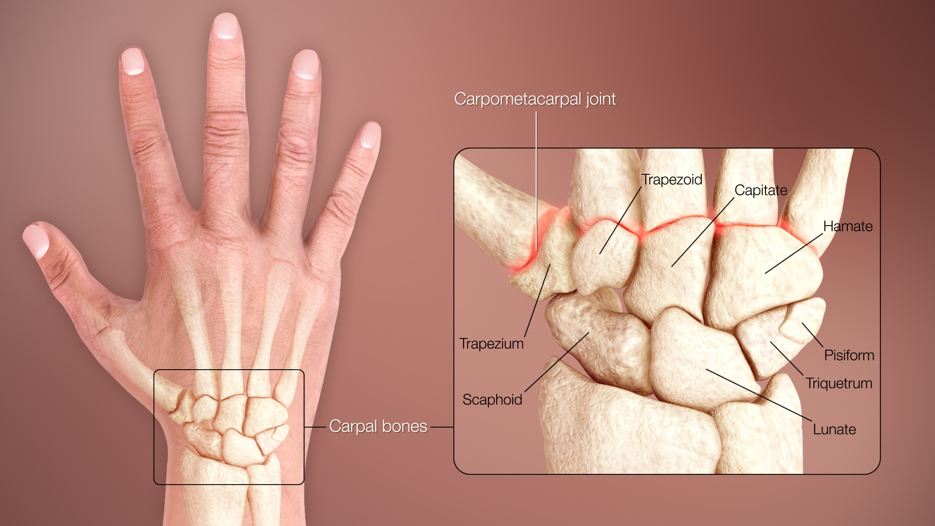 az első kétpontos carpal metacarpalis ízület artrózisa