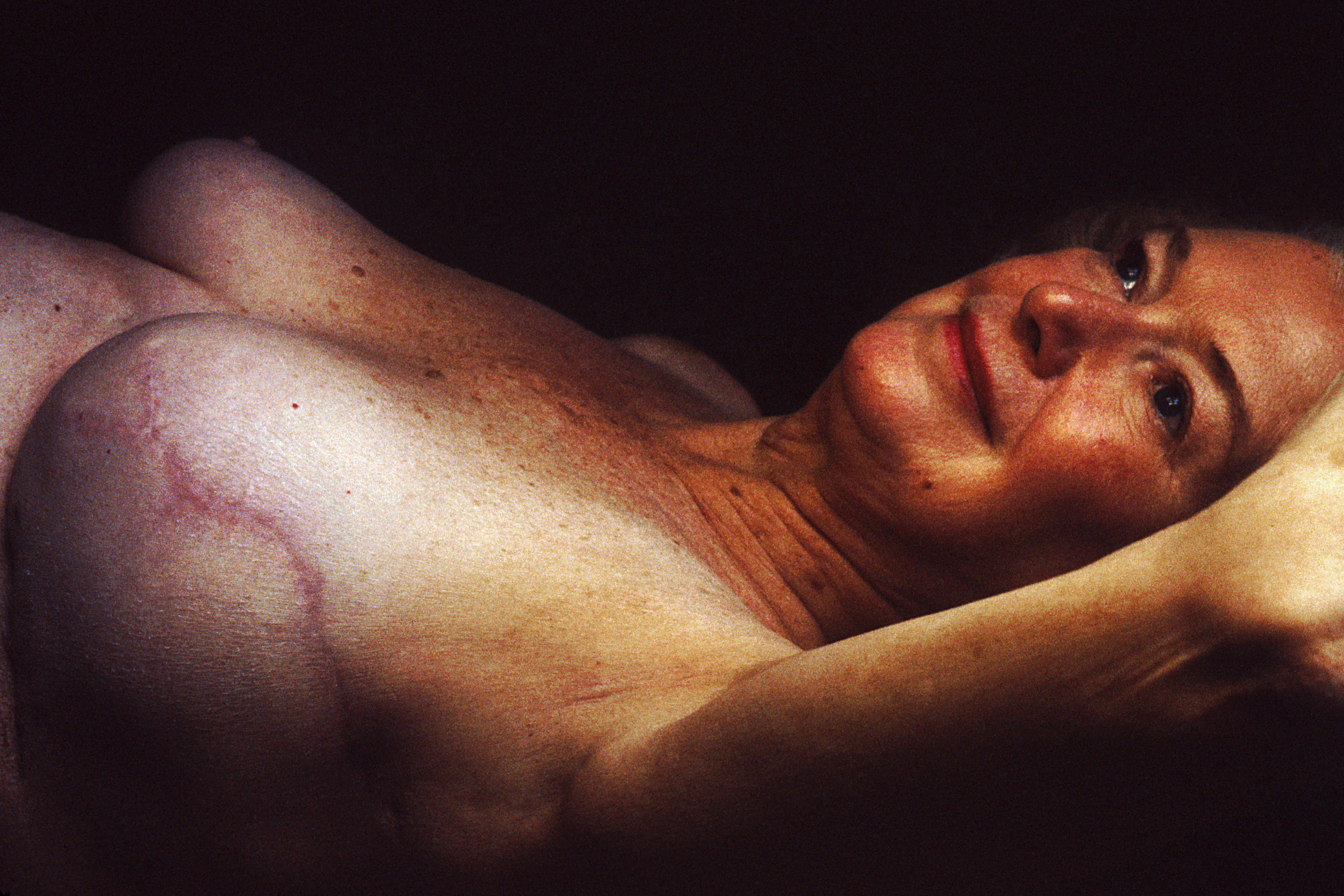 Double mastectomy 'does not reduce mortality' for unilateral