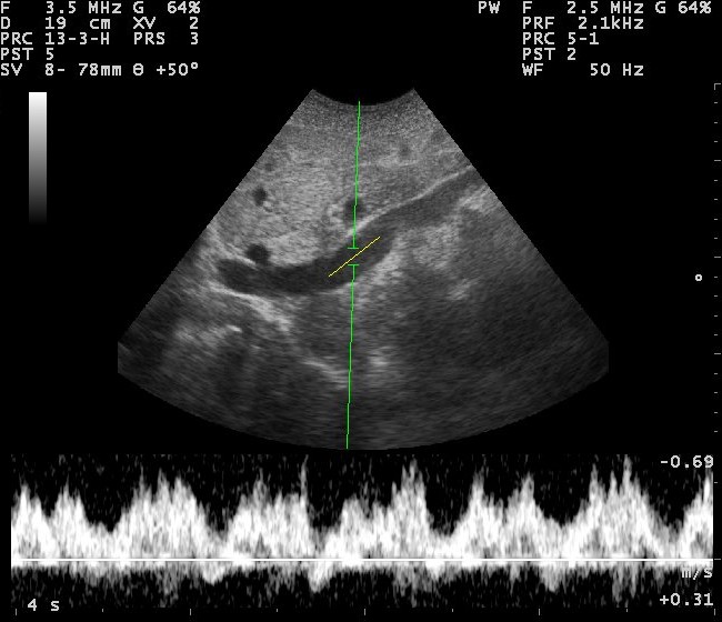 File:Doppler ultrasound image of inferior vena cava 110314102702 1036230.jpg