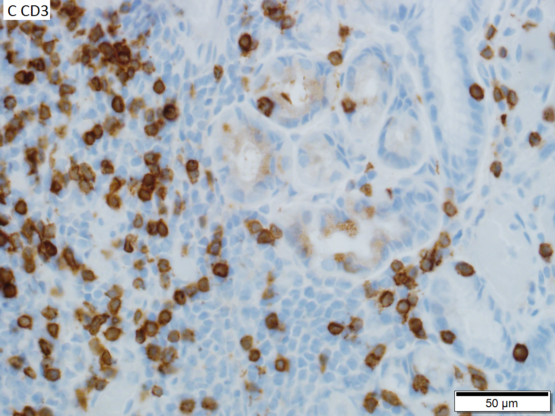 MALT lymphoma of stomach