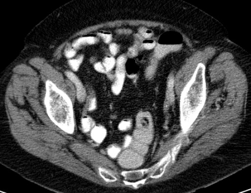 File:Hufeisenniere 02 - CT - axial - 008.jpg