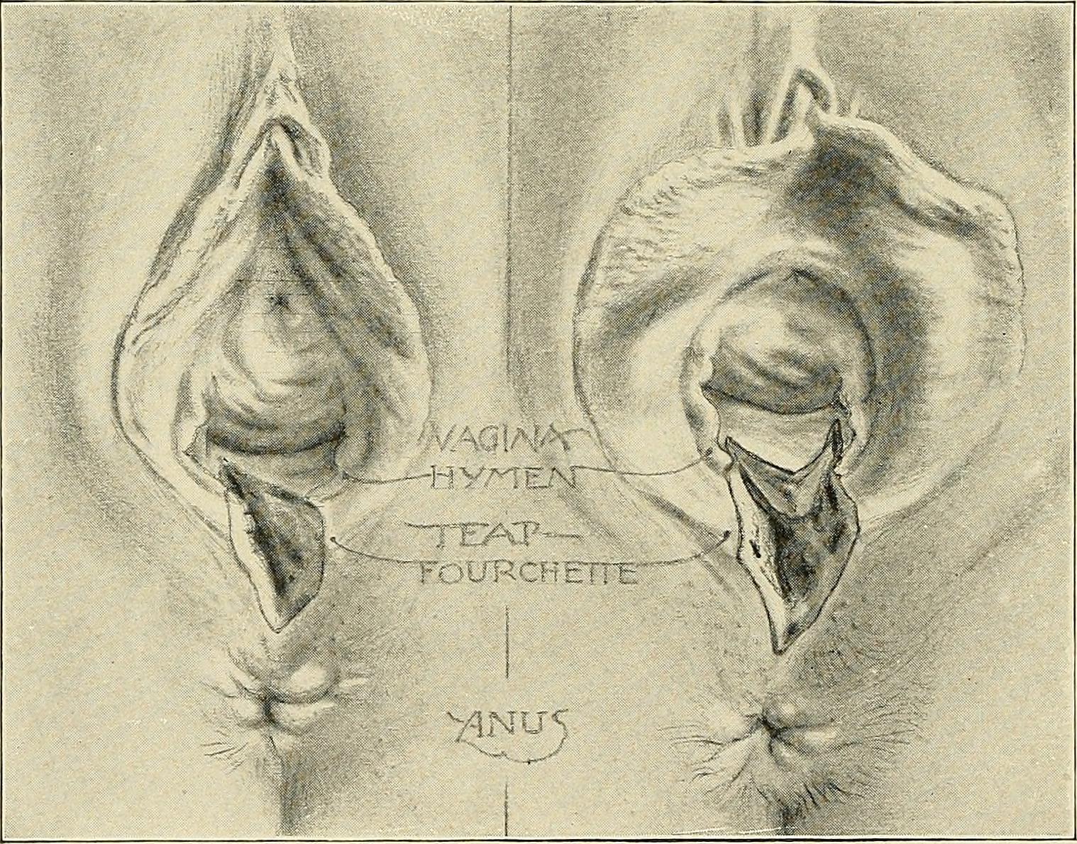 Perineal tear Wikipedia. en.wikipedia.org. 