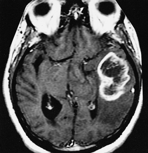 PDF) Ring enhancing lesions on neuroimaging of childhood symptomatic  epilepsy-A clinico-pathological study