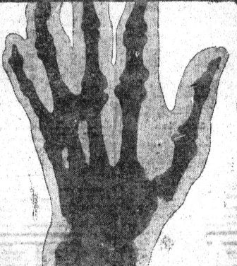 File:Deacon McGuire hand x-ray.jpg