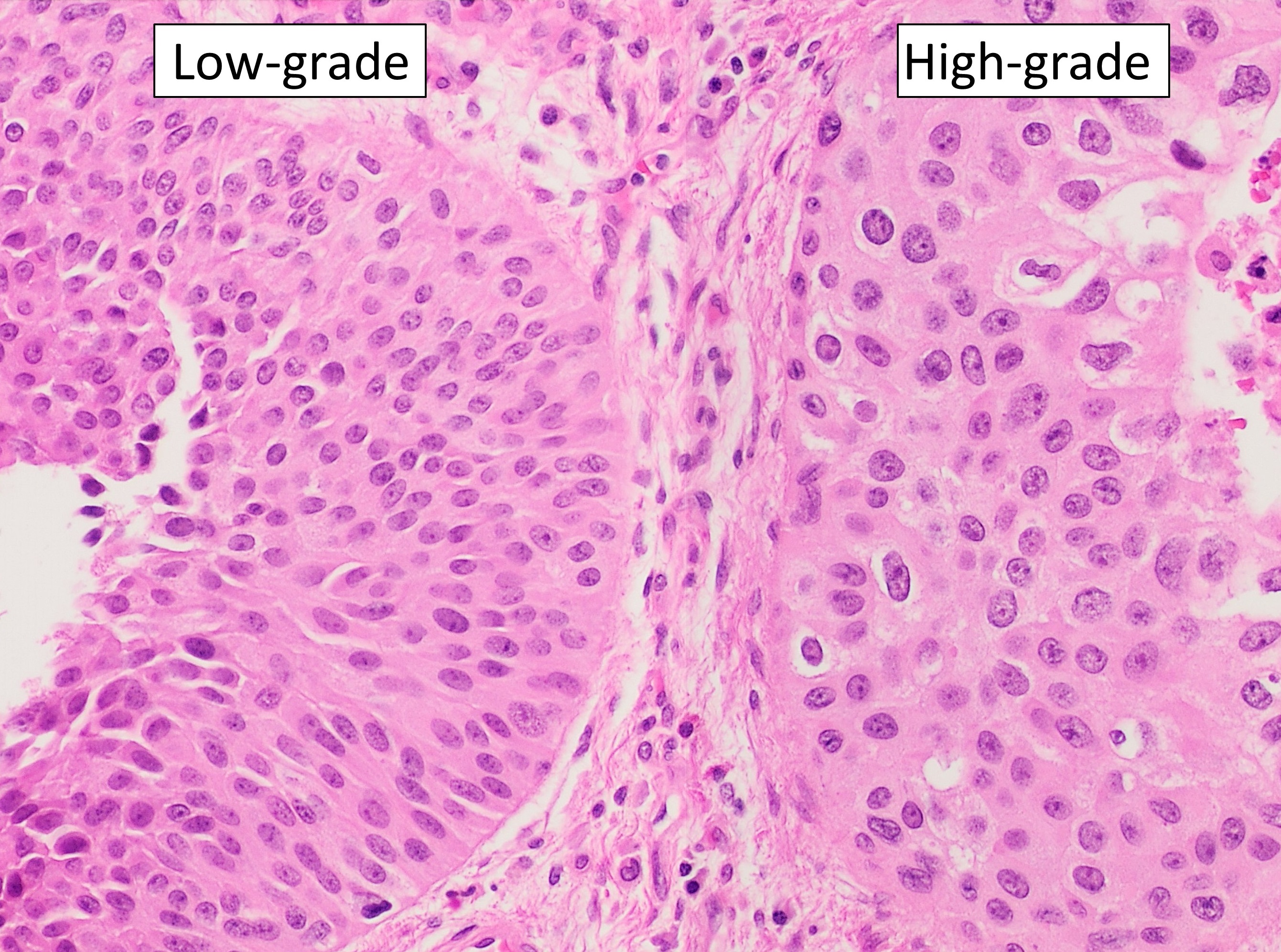 Qué significa carcinoma