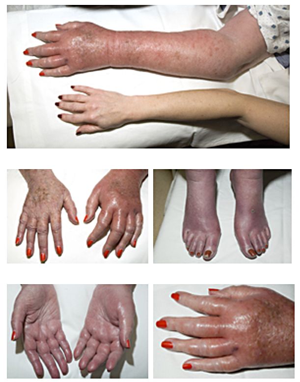 Erythromelalgia.jpg on WikiMedia by Herbert L. Fred, MD and Hendrik A. van Dijk