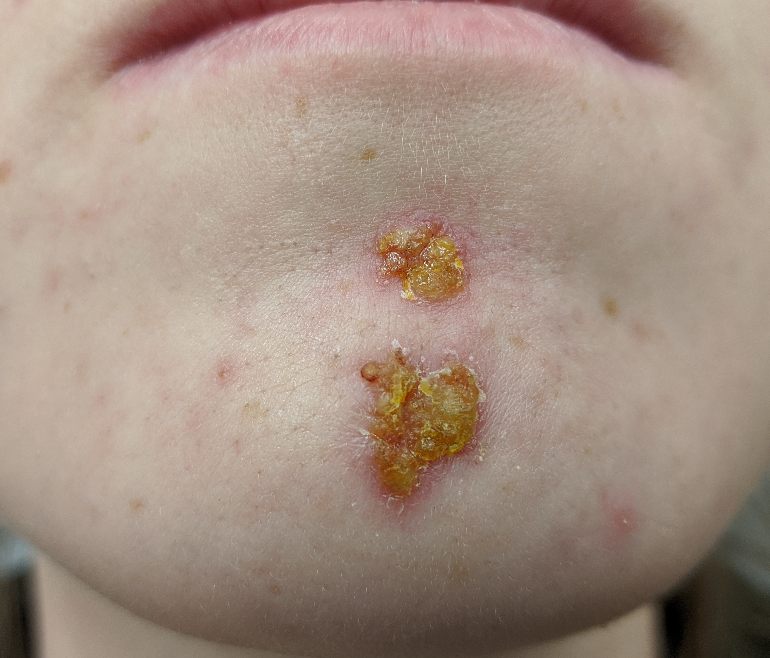 nasal impetigo