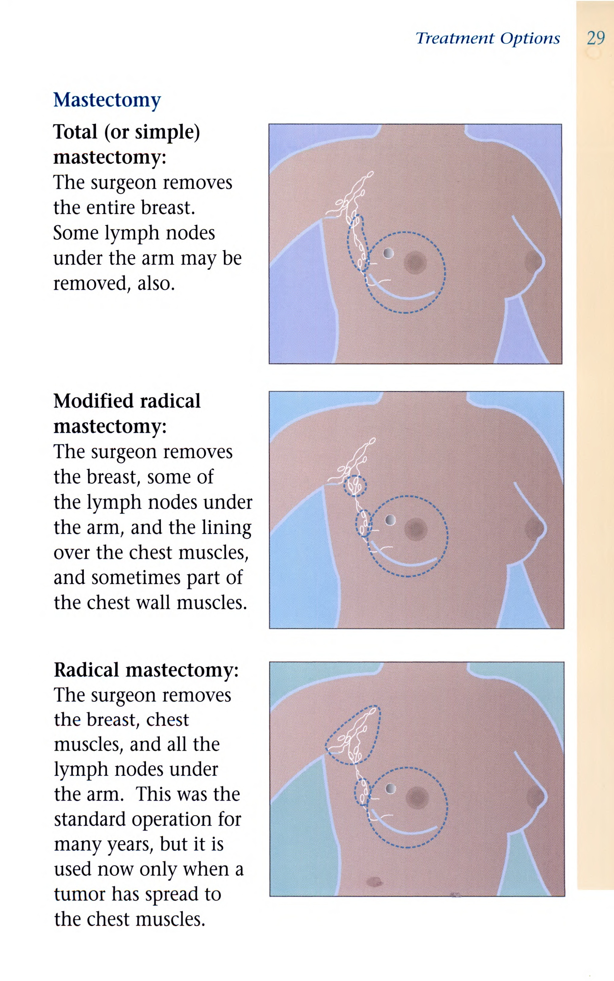 Mastectomy Options for Breast Cancer Patients