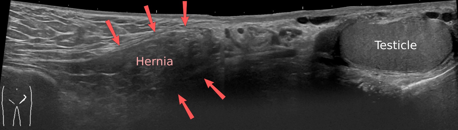 Lateral Inguinal Fossa Wikipedia