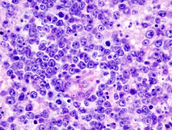 File:CNS lymphoma (2) B-cell type.jpg