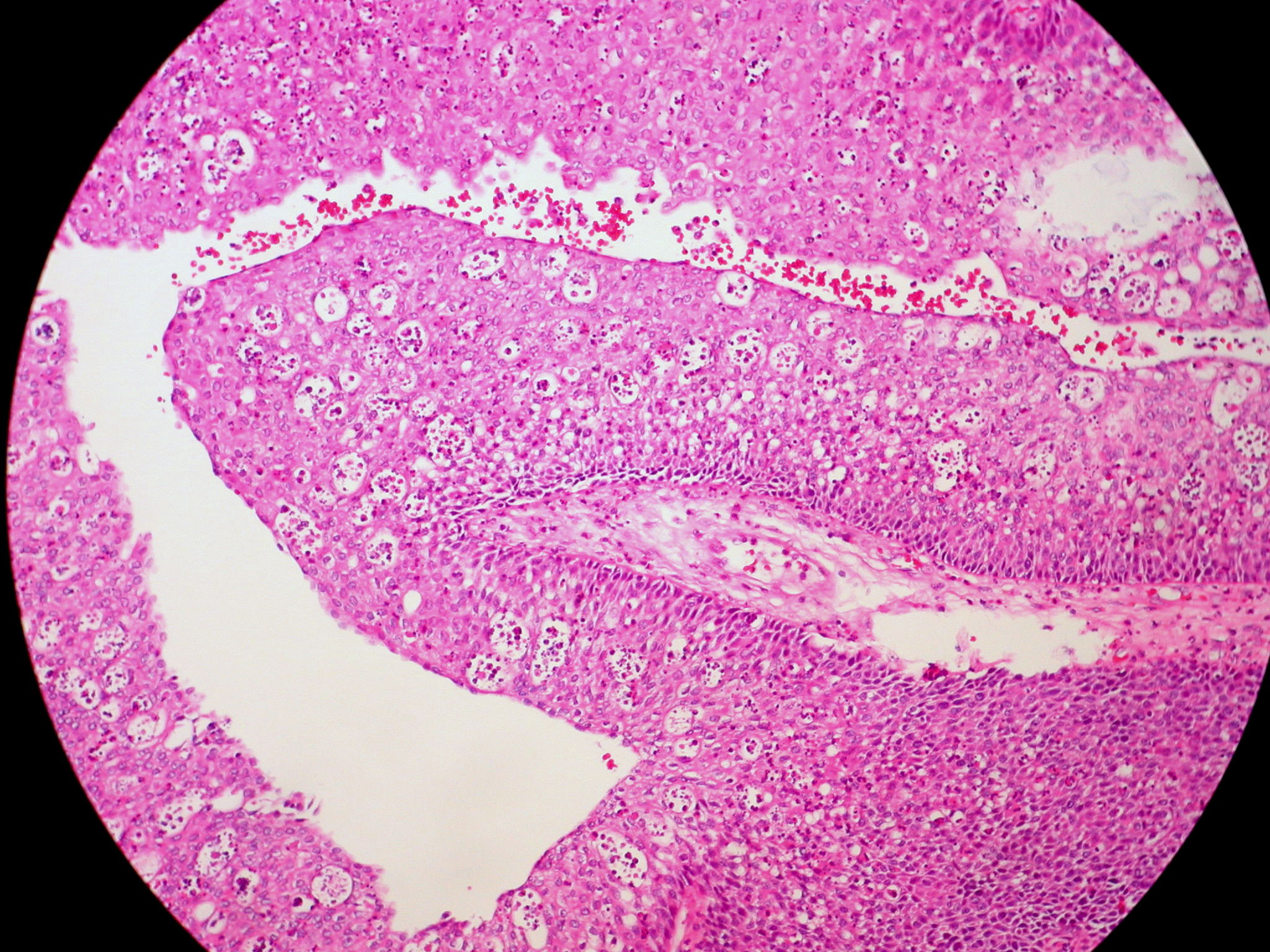 inverted nasal papilloma