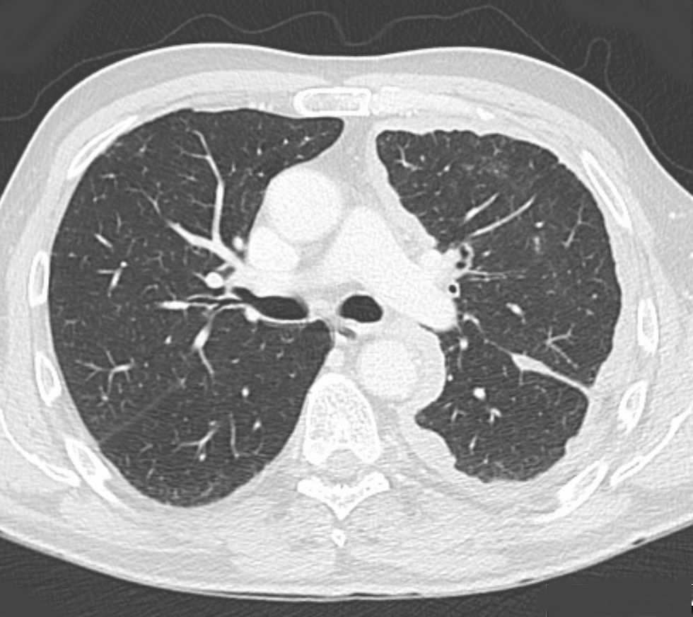 Malignant Pleural Mesothelioma Pacs Suche Fur Radiologen