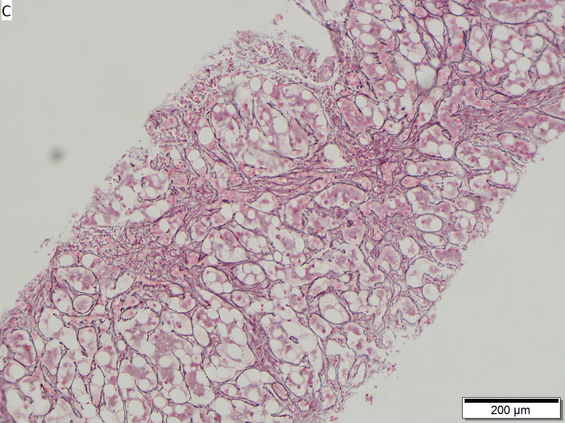 Wilson’s disease with cirrhosis