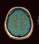 Анімована МРТ-сканування здорового мозку.