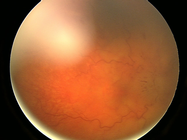 File:Fundal photograph showing severe papilloedema in the right eye.jpg