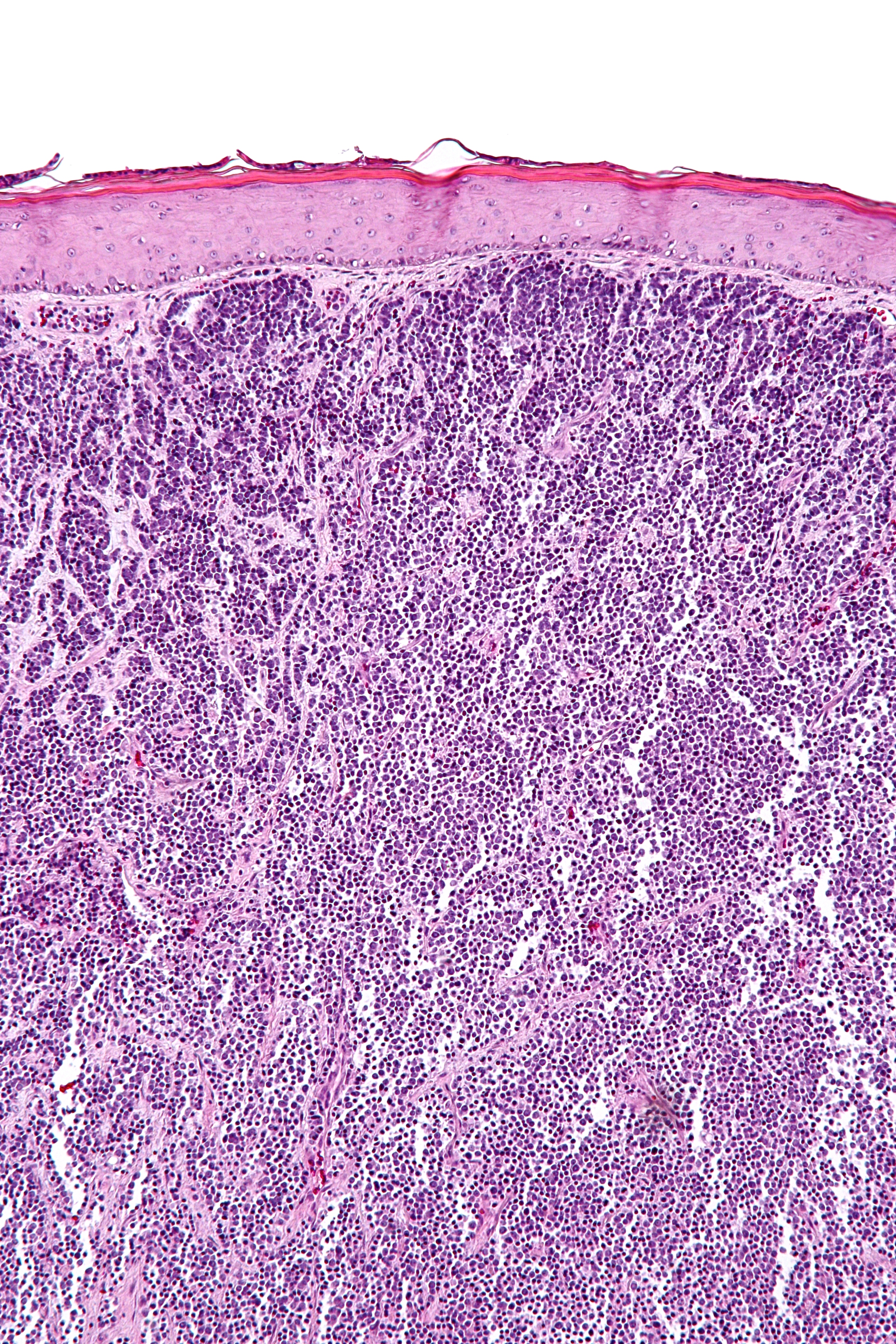 merkel cell carcinoma histology