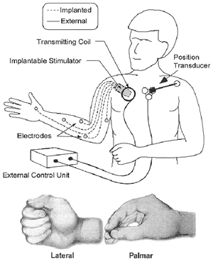 A schematic of the neuroprosthesis showing the external control unit