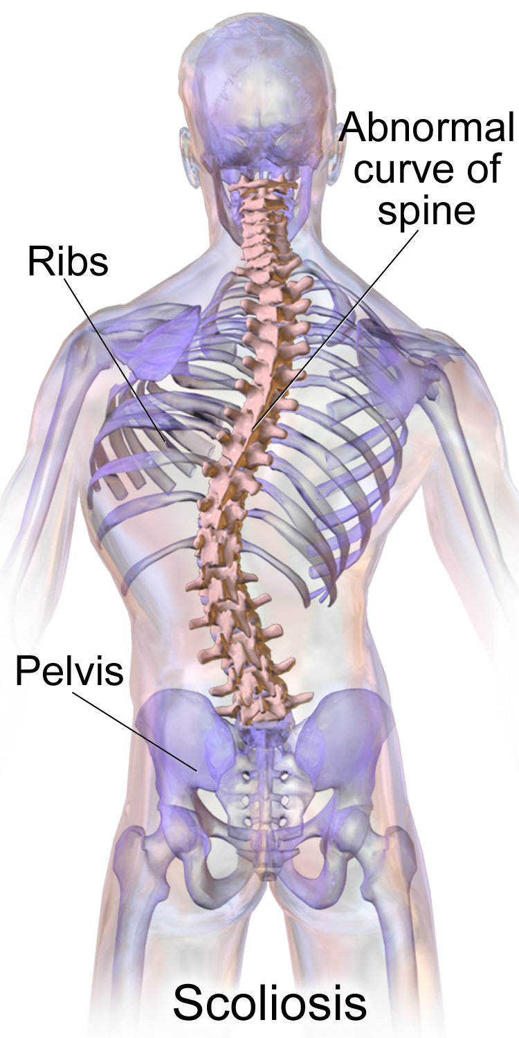 All About 'S'-Shaped Scoliosis