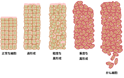 File:Cancer progression from NIH japanese.png