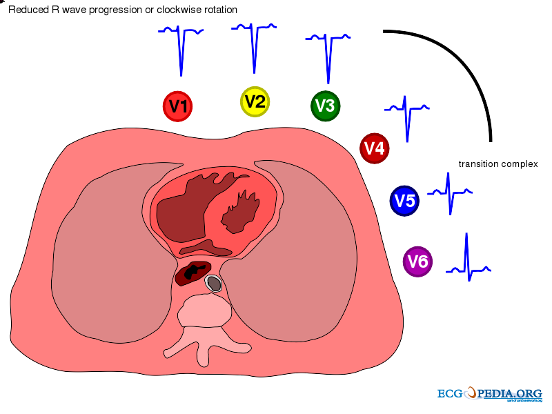 File:De-Reduced rwaveprogression (CardioNetworks ECGpedia).png