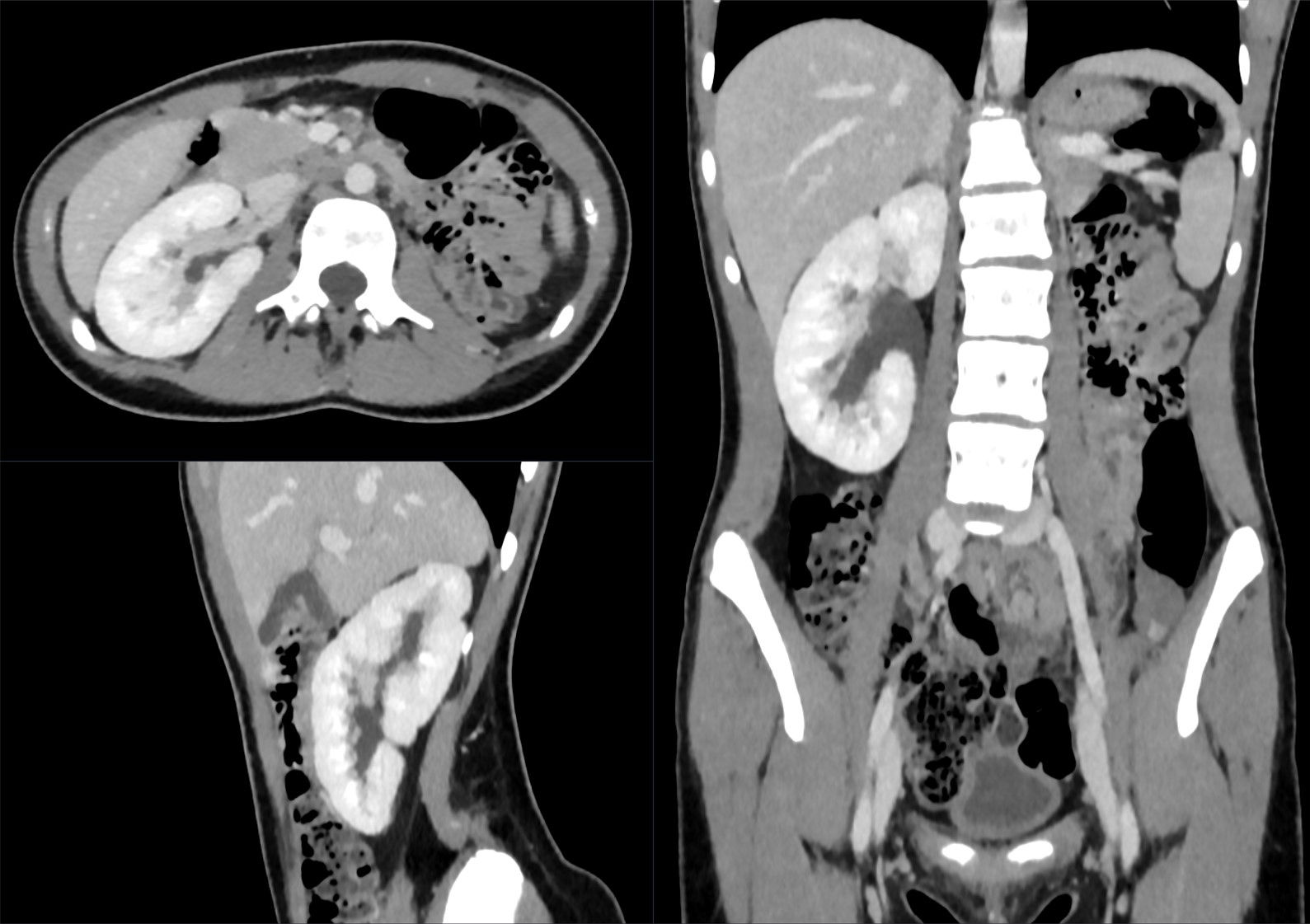 Gartner's duct cyst - Wikipedia