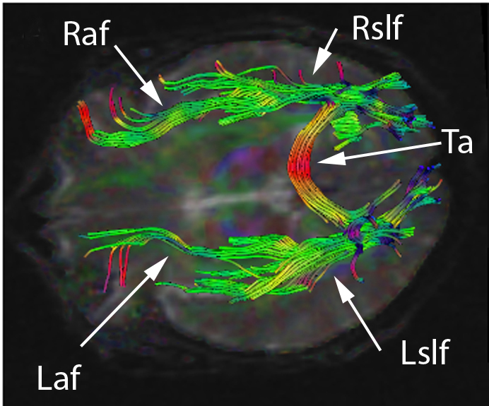 File:DTI Brain Tractographic Image A panal.jpg