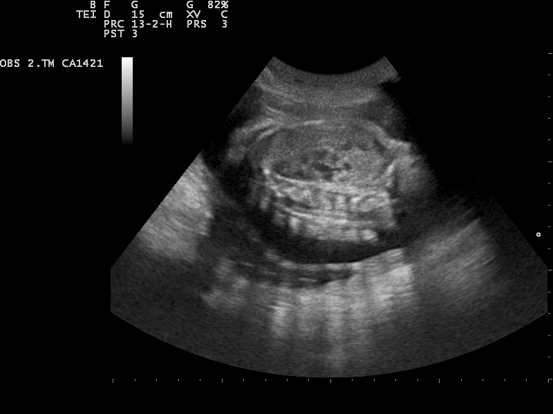 File:Ultrasound Scan ND 0117151555 1523460.png