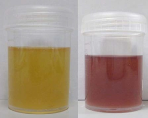 File:Urine of patient with porphyria.png