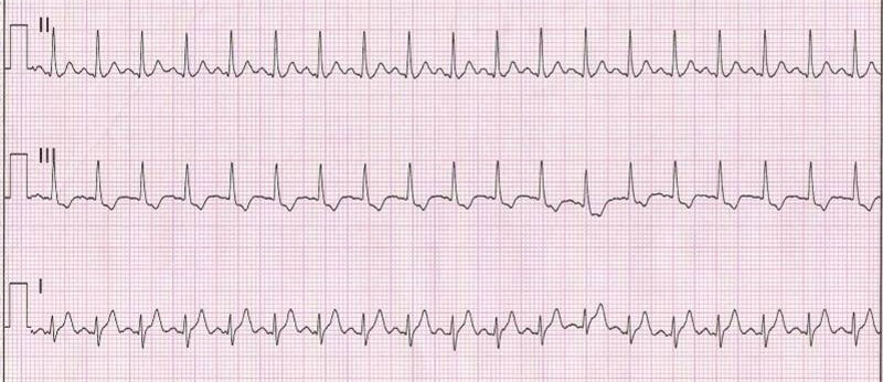 sinus tachycardia