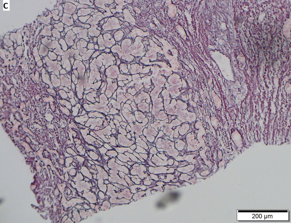 Hepatocellular carcinoma arising in cirrhosis