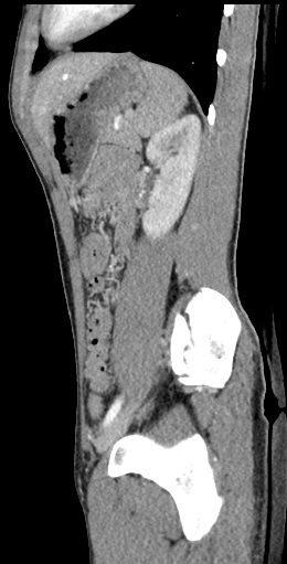 CT of a normal abdomen and pelvis, sagittal plane 118.png