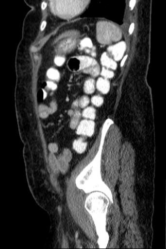 File:Hufeisenniere 06 - CT - sagittal - 045.jpg