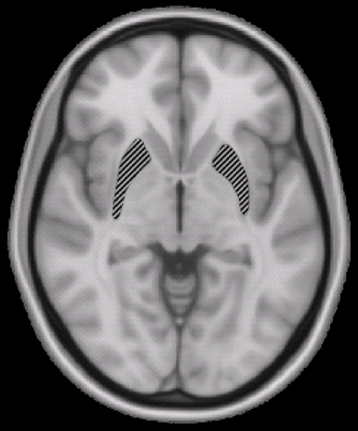 MRI image of the human brain, Putamen highlighted. https://upload.wikimedia.org/wikipedia/commons/a/aa/Putamen.jpg Public domain image