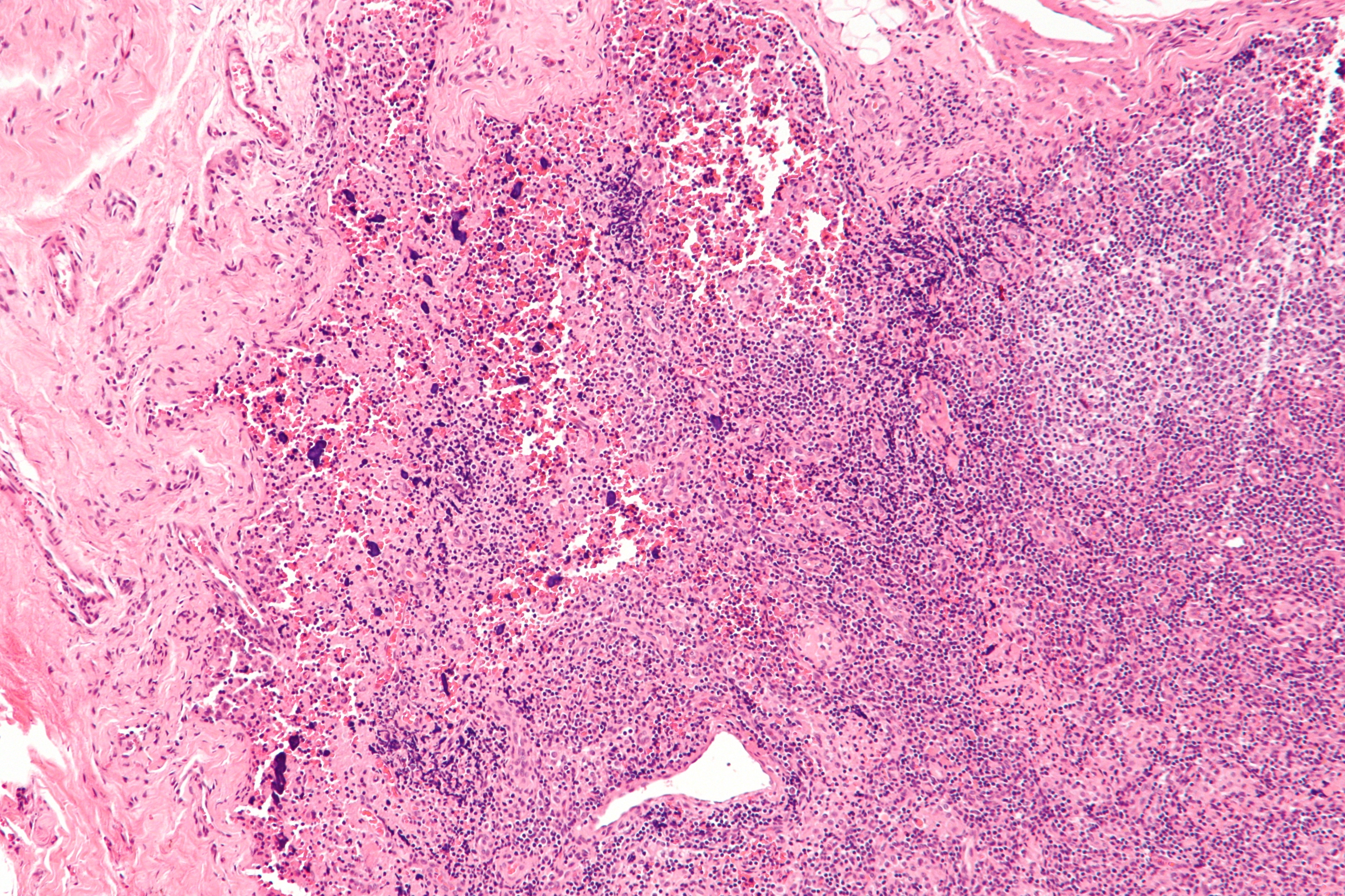 Systemic Lupus Erythematosus lymphadenopathy showing inflammation and swelling