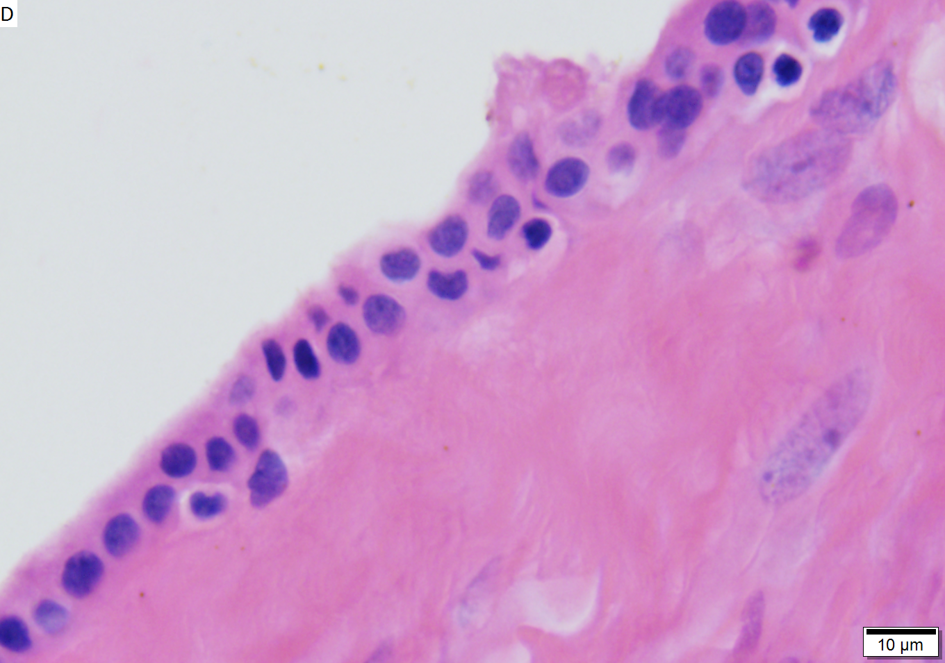 Mucinous cystic neoplasm of pancreas