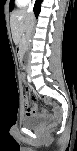CT of a normal abdomen and pelvis, sagittal plane 85.png