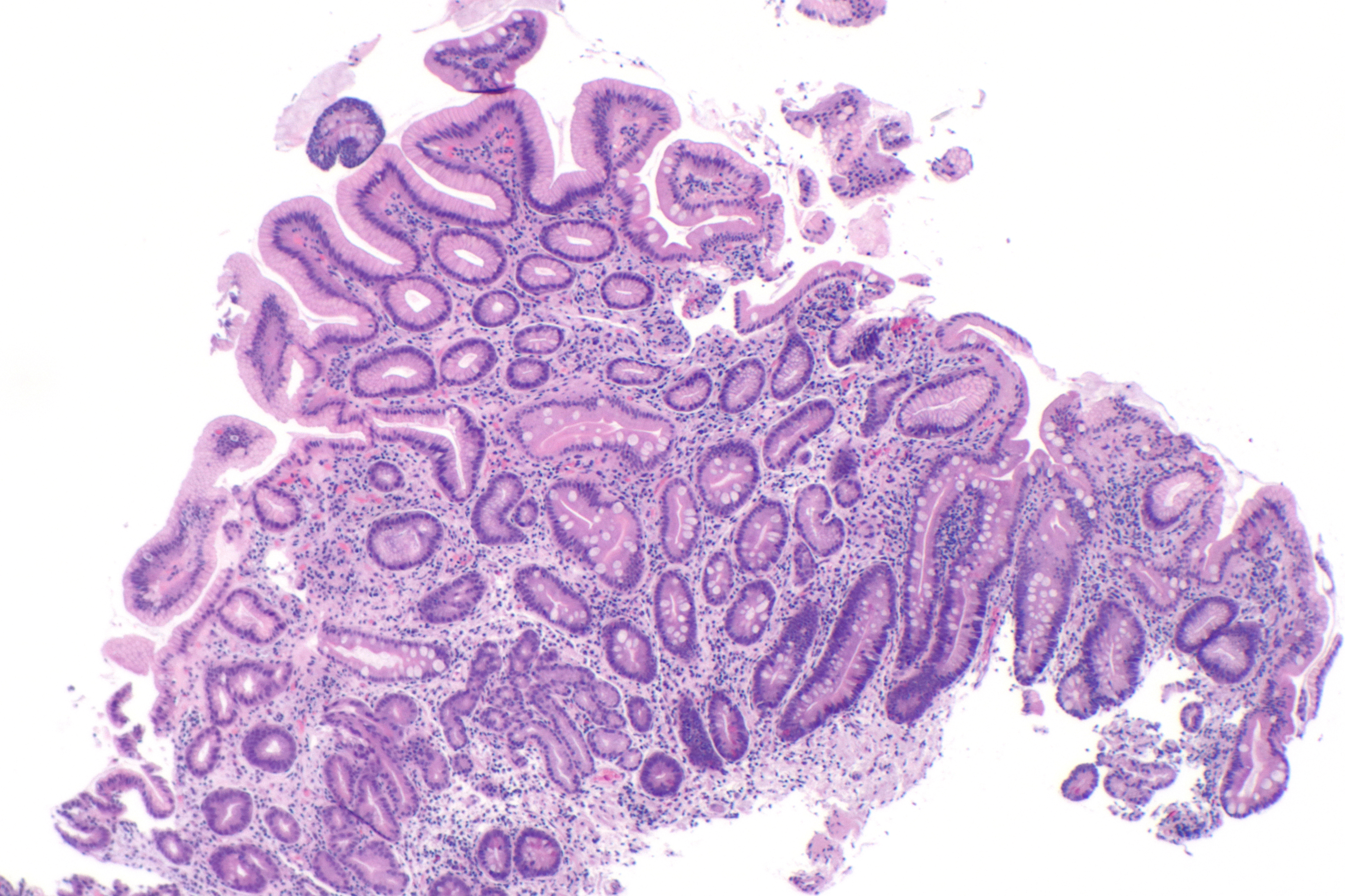 atrophic gastritis histology