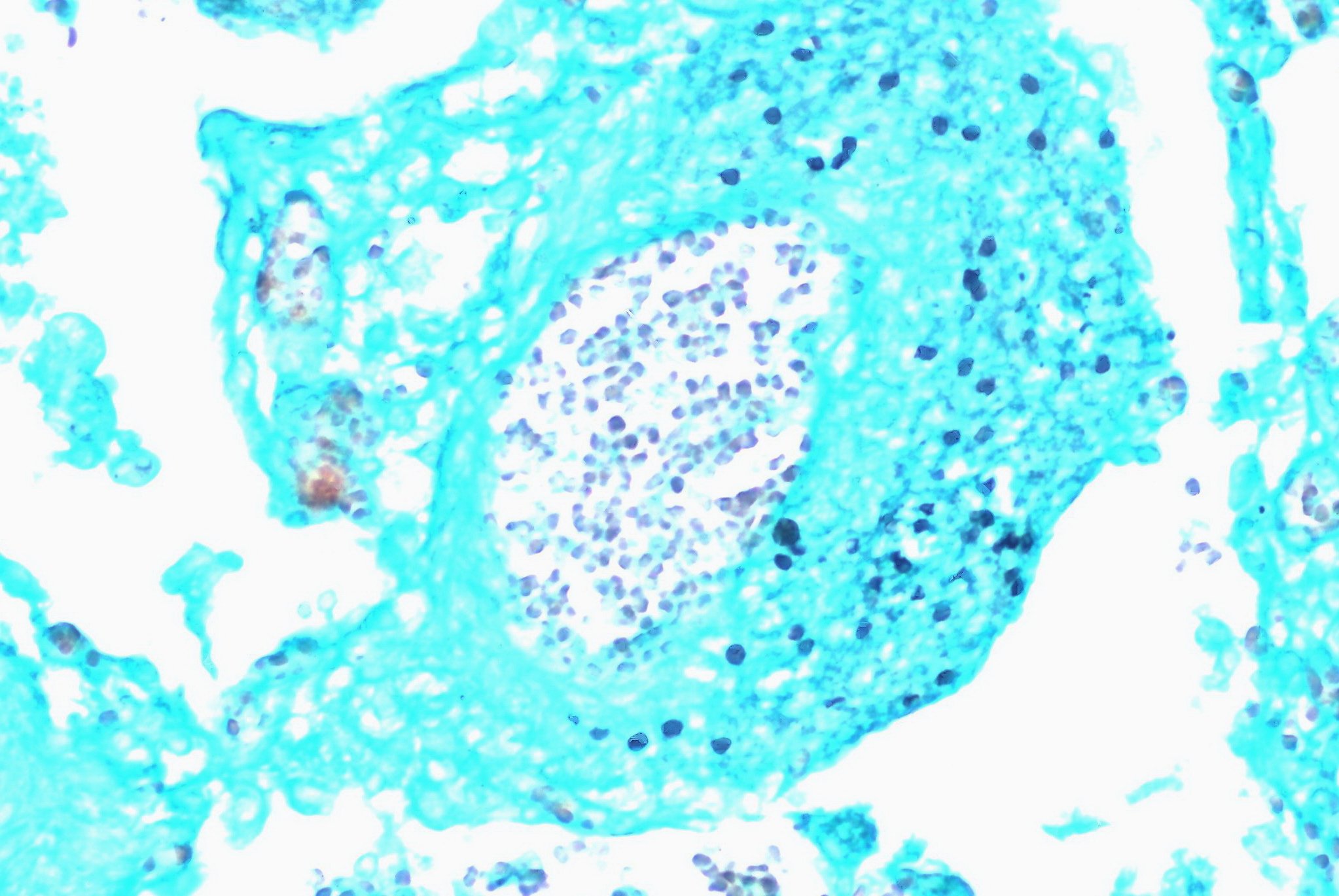 Пневмоцисты. Pneumocystis jirovecii. Пневмоцисты микроскопия. Пневмоциста гистология.