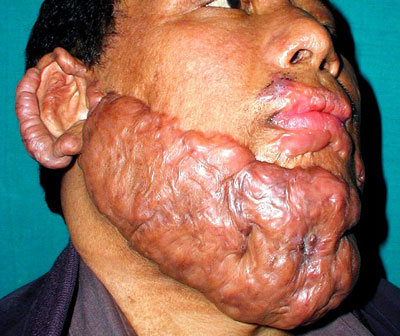 File:Verbrennungsnarbe keloid1.jpg