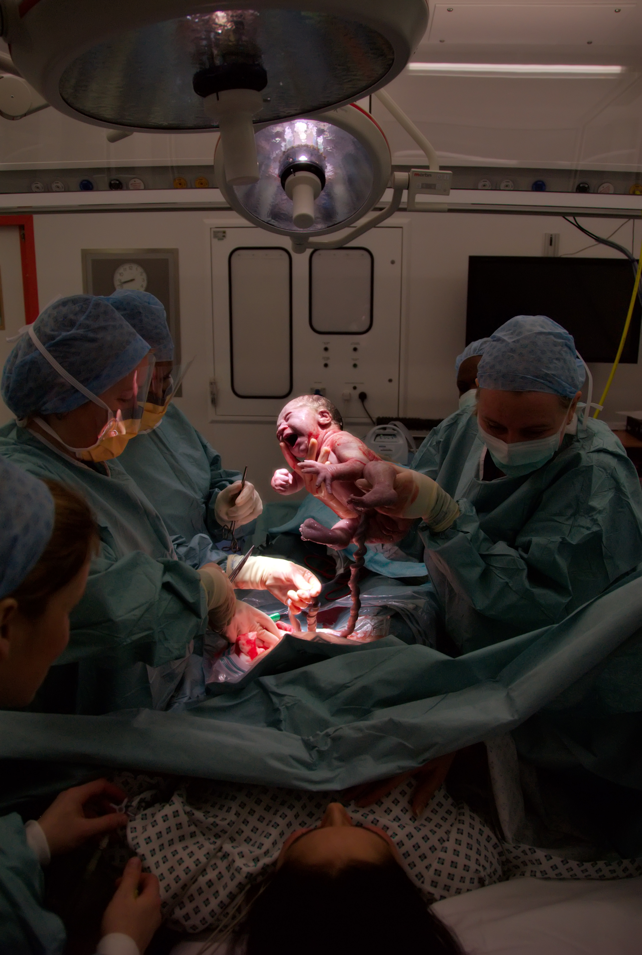 How Many C-Sections Can You Have: Risks of Repeat C-Sections