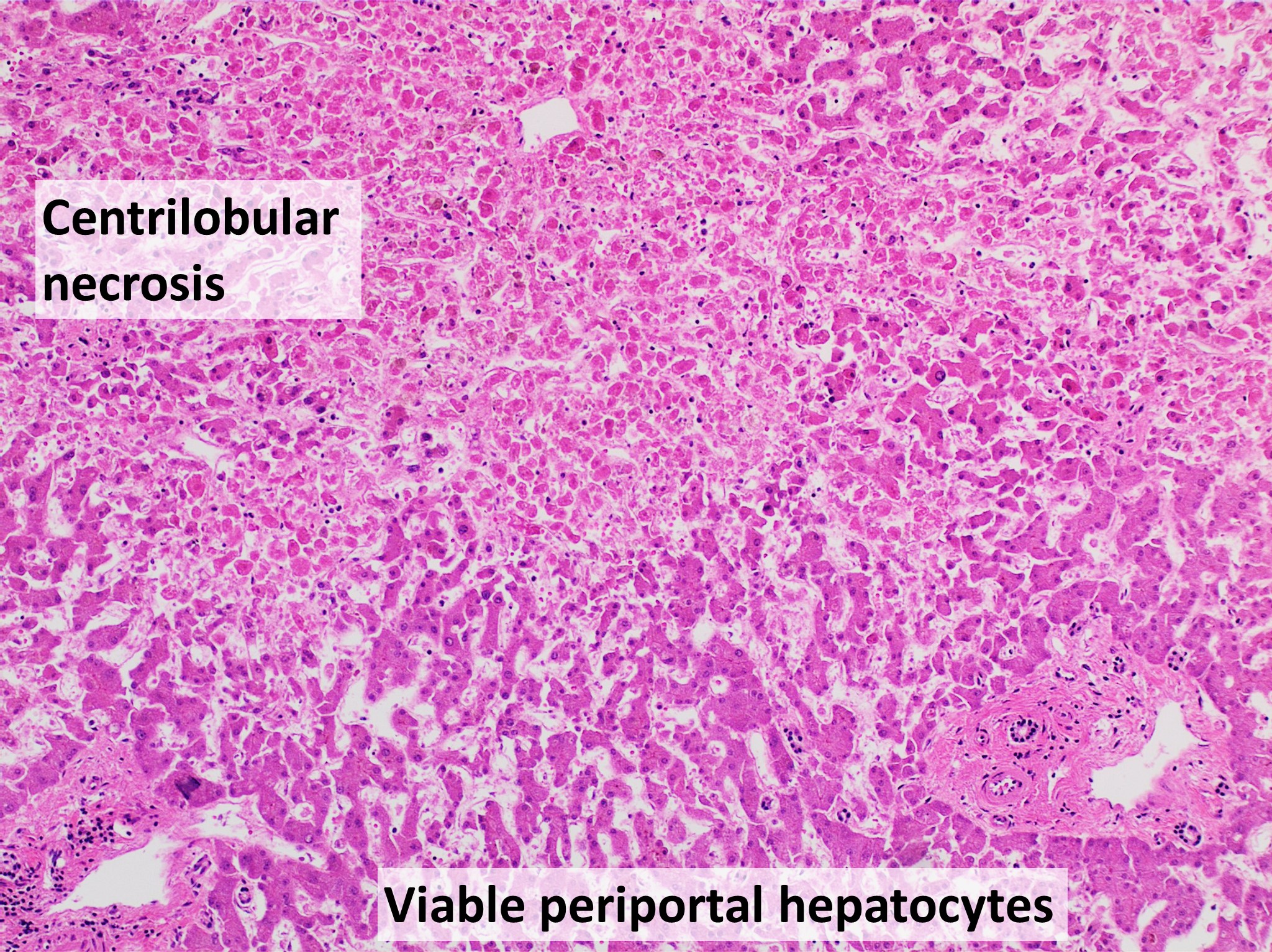 hepatitis b liver histology