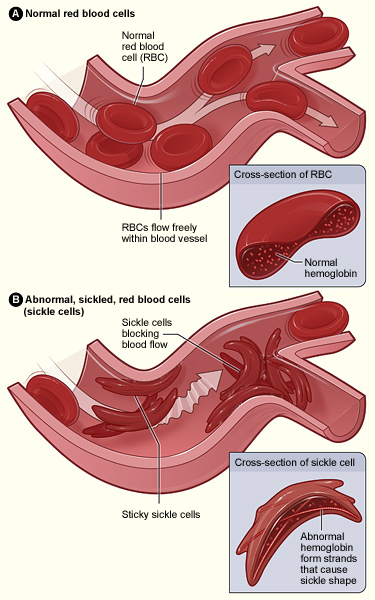 File:Sickle cell 01.jpg