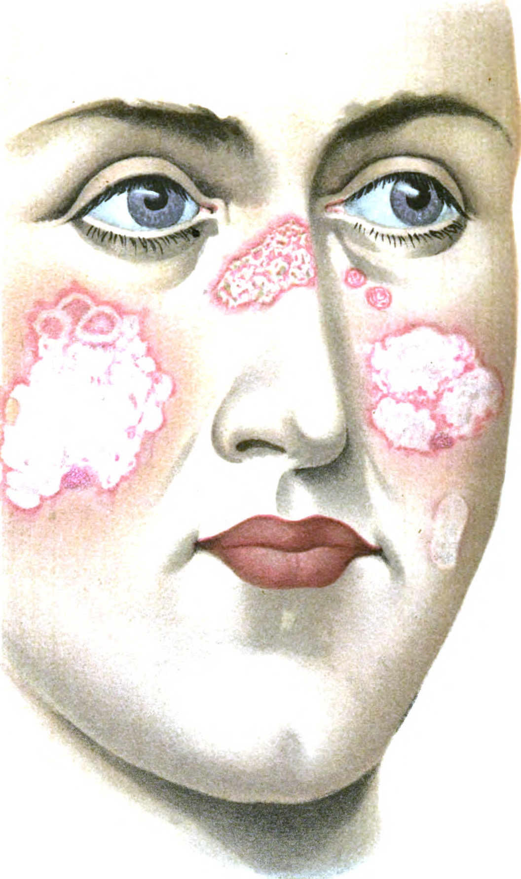 An introduction to dermatology (1905) lupus erythematosus 2.jpg