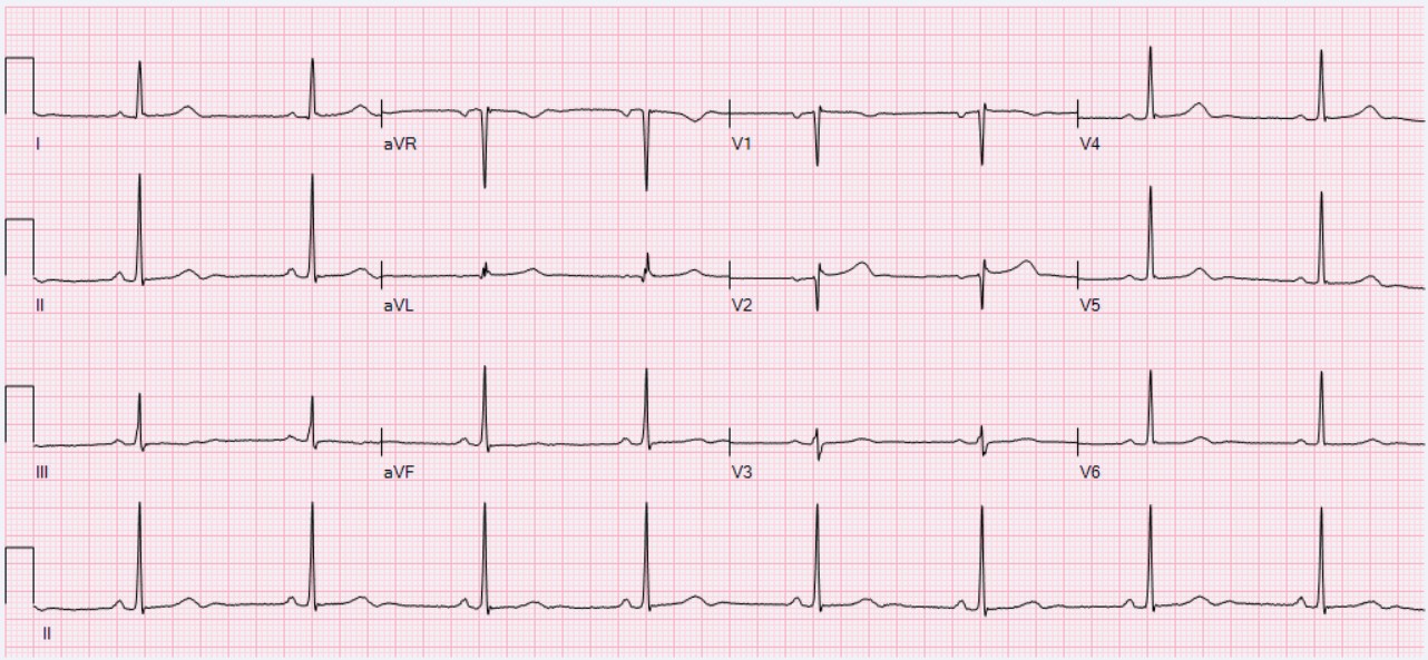 File Ecg Sinus Bradycardia 49 Bpm Jpg Wikipedia