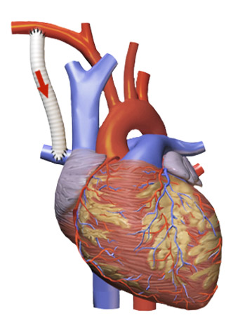 Blalock Taussig Shunt - Aortic to Pulmonary.png