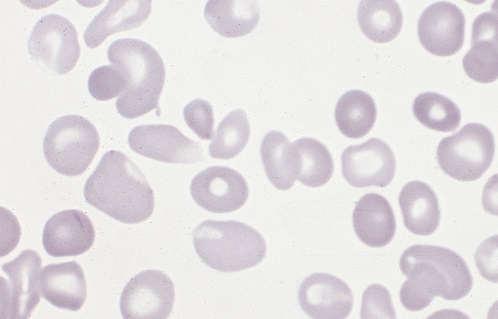 anisocytosis rbc