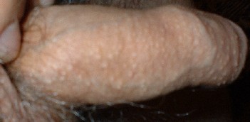 File:Human penis with Fordyce's spots.jpg